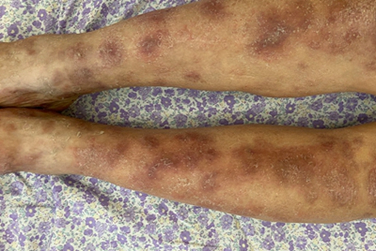 亚急性湿疹小腿斑图