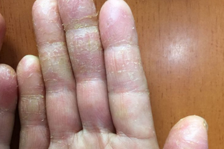 掌跖角皮症手指症状图