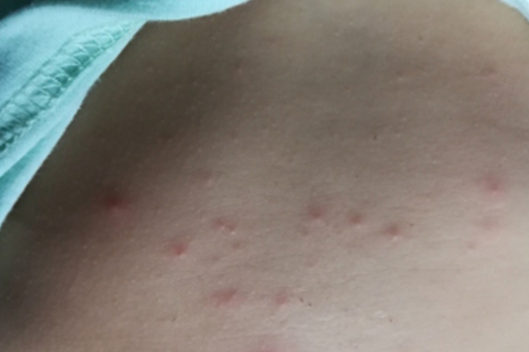 丘疹性荨麻疹图