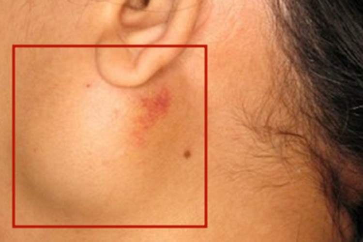 腮腺皮样囊肿耳周症状图 腮腺皮样囊肿耳周症状图