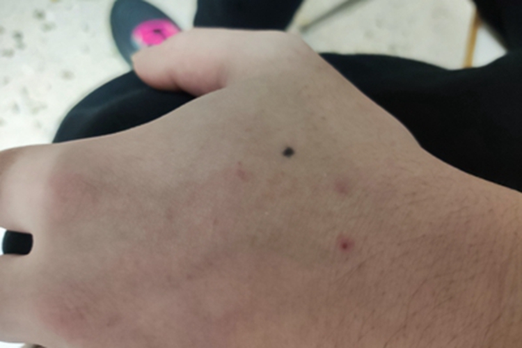 交界痣手背黑痣图