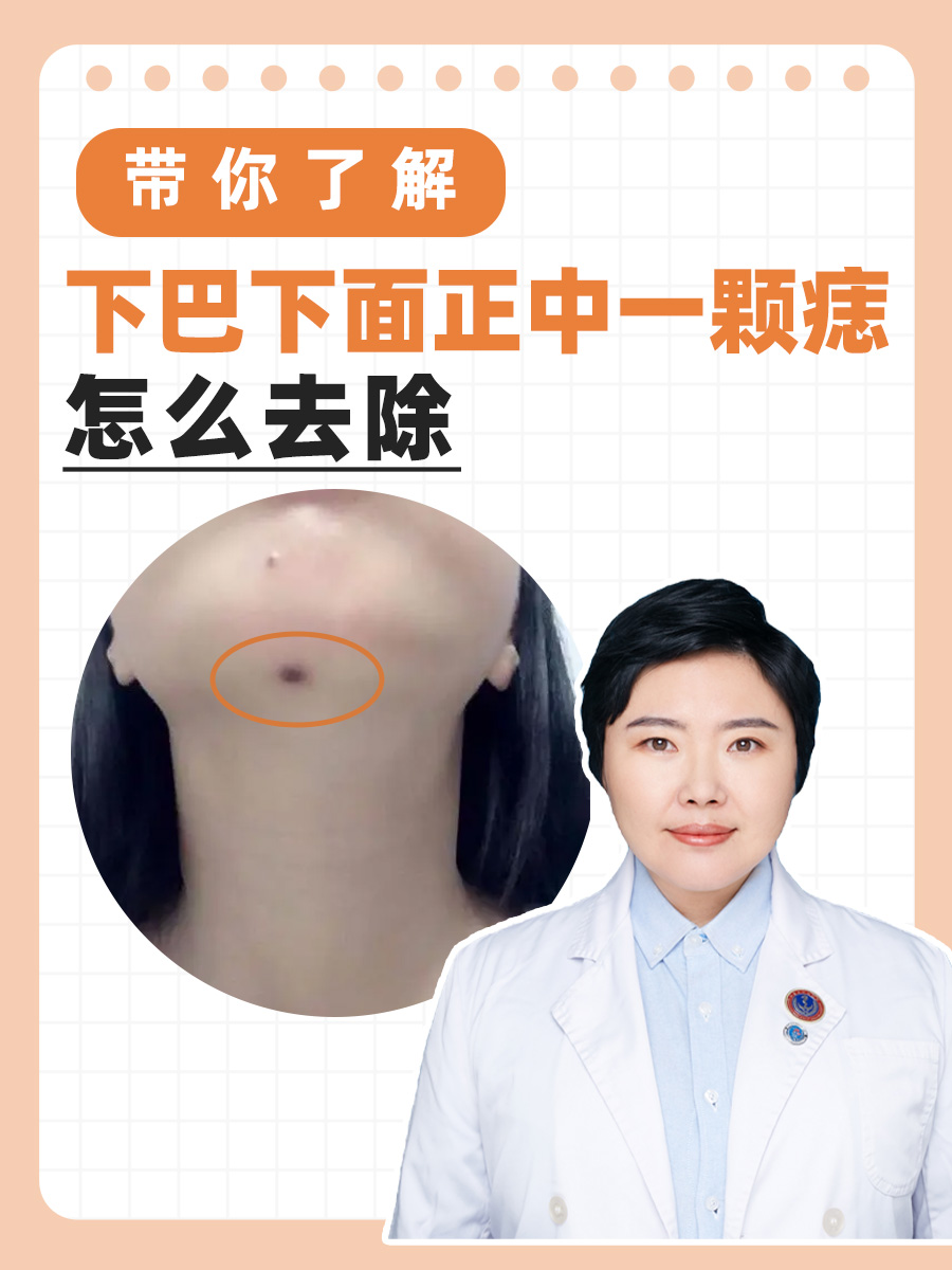 带你了解：下巴下面正中一颗痣怎么去除