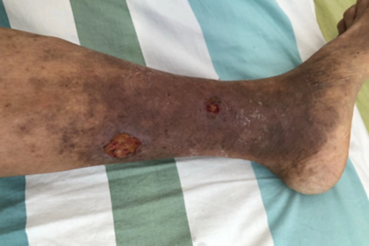 静脉曲张性溃疡小腿溃疡图 静脉曲张性溃疡小腿溃疡图