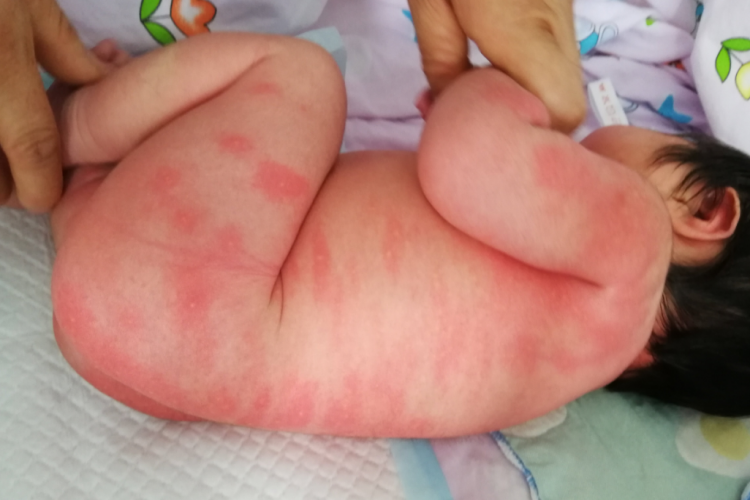 新生儿中毒性红斑全身脓包图
