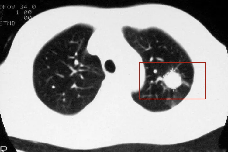 血行播散性肺结核CT图 血行播散性肺结核CT图