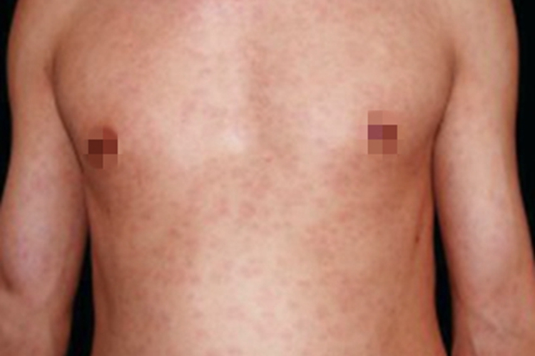 二期梅毒全身红斑图