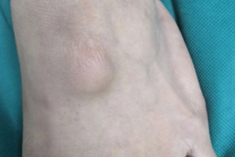 腱鞘囊肿脚背大包图