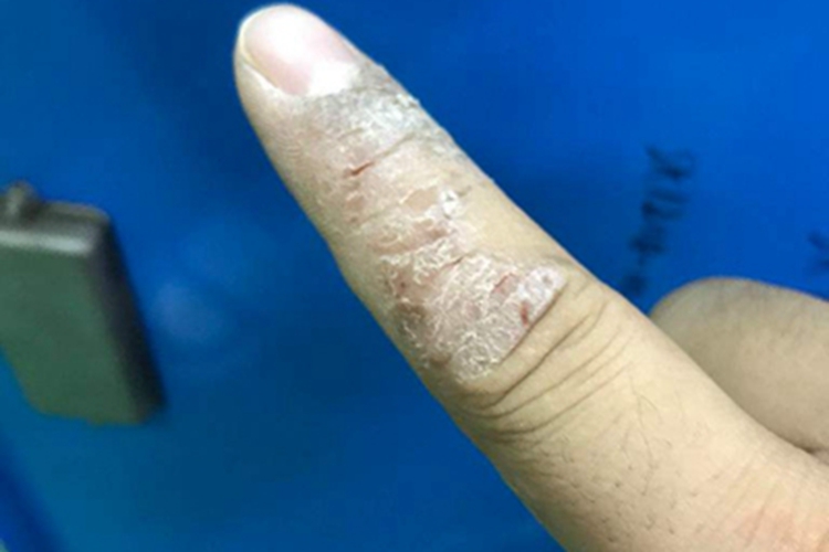 皲裂性湿疹手部结痂图