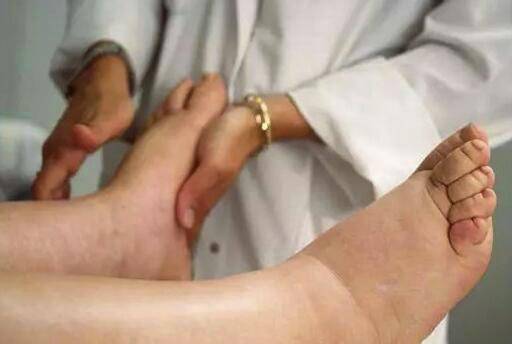 宫颈癌下肢水肿图