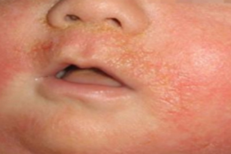 急性湿疹脸发红有黄色痂皮图 急性湿疹脸发红有黄色痂皮图