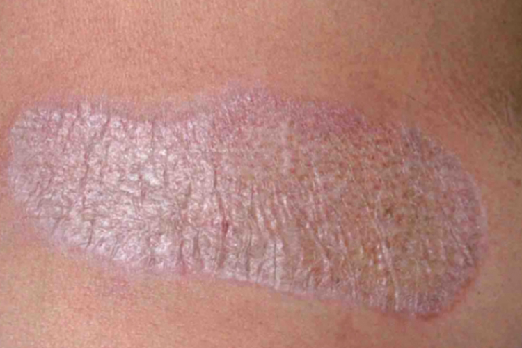 羊皮纸样萎缩苔藓图