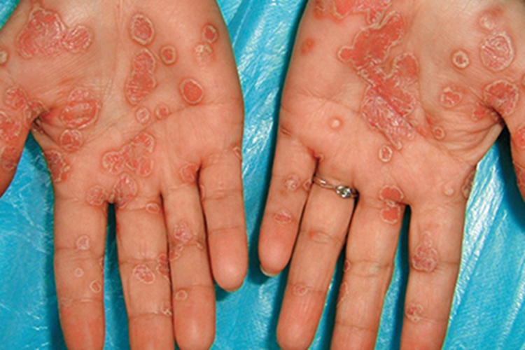 女性二期梅毒红斑图