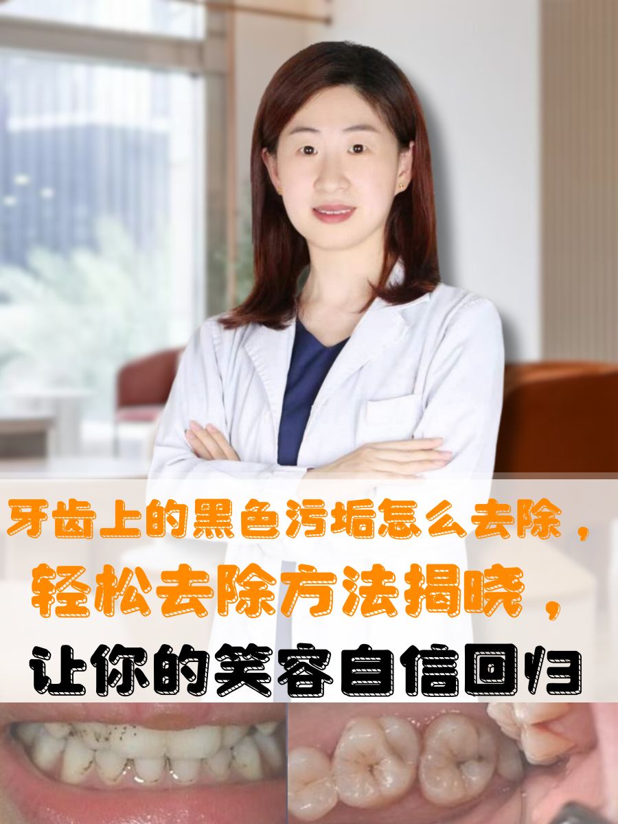 牙齿上的黑色污垢怎么去除,轻松去除方法揭晓,让你的笑容自信回归