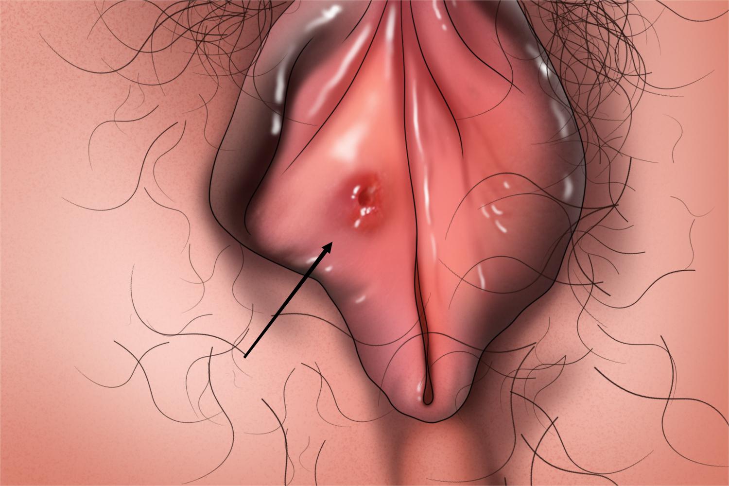 急性外阴溃疡症状图