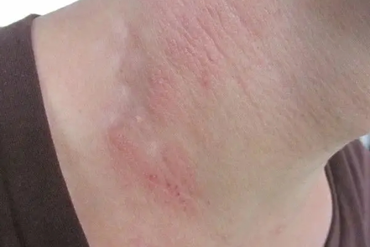 脖子湿疹图 脖子湿疹图