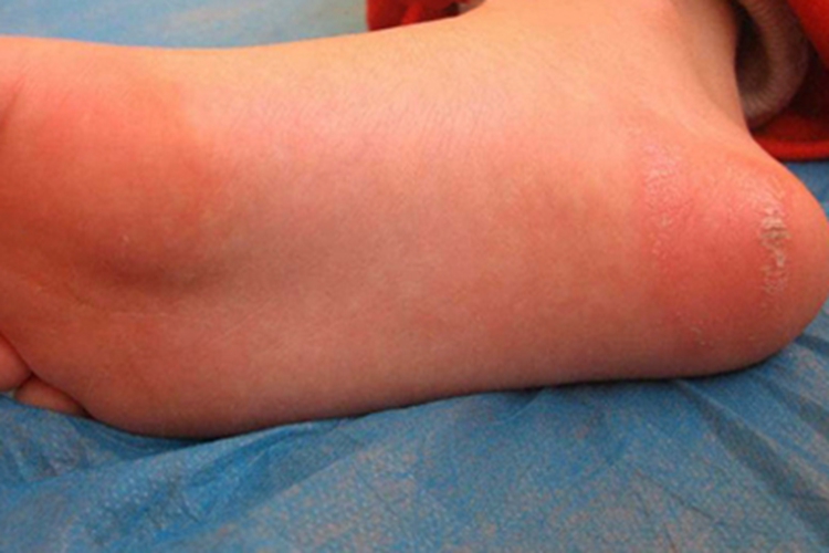 幼年性跖部皮病脚底红斑图