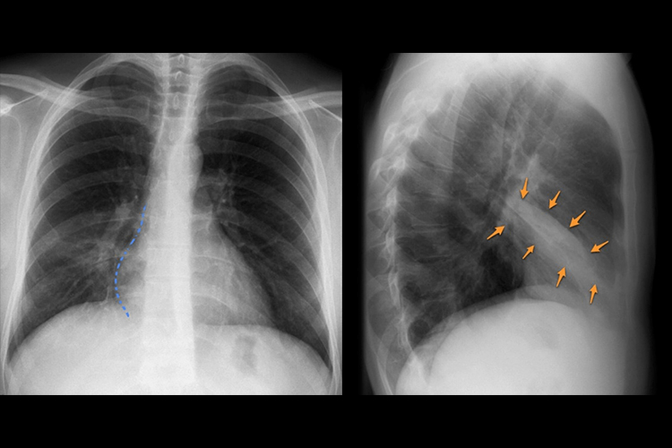 肺内片状模糊影图