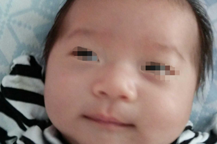 5P-综合征眼距过宽图