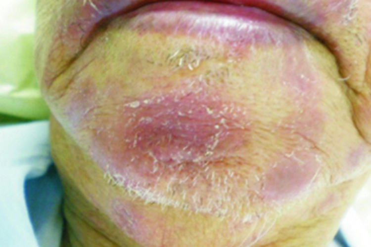 黏蛋白病下巴红斑脱屑图