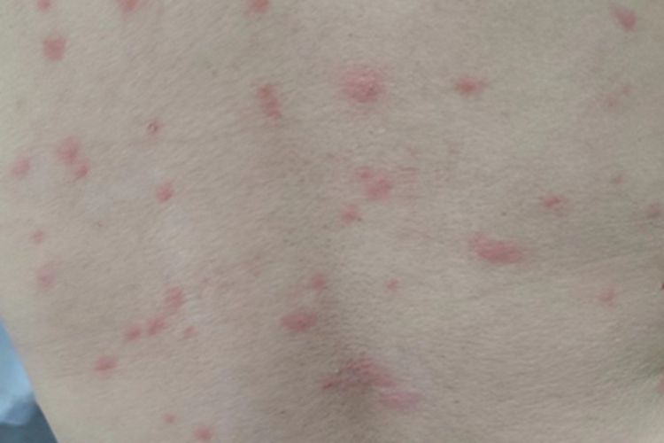 急性自发性荨麻疹背部丘疹图