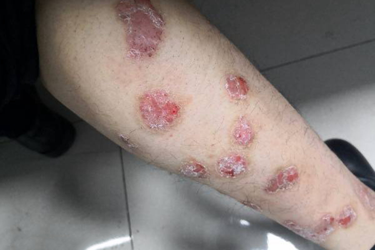 艾滋病小腿有银屑病皮疹图