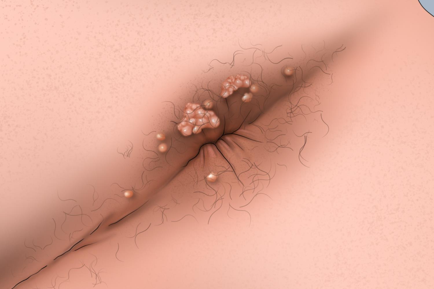 肛门感染HPV病毒症状图