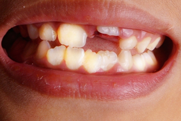 小儿生长激素缺乏症牙齿症状图 小儿生长激素缺乏症牙齿症状图