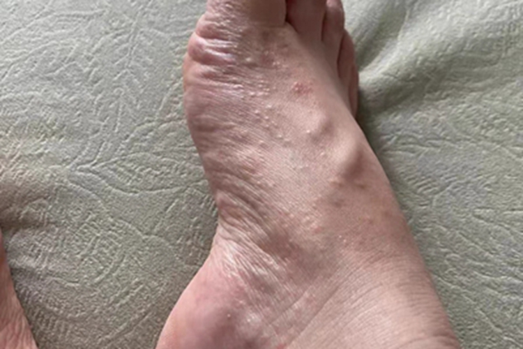 急性湿疹脚部症状图
