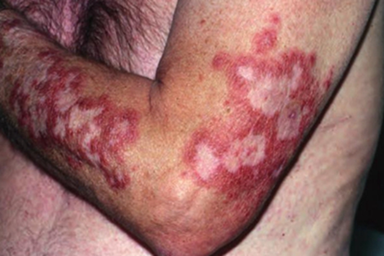 亚急性皮肤型红斑狼疮症状图