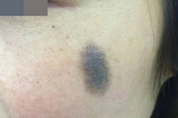 色素型胎记面部症状图