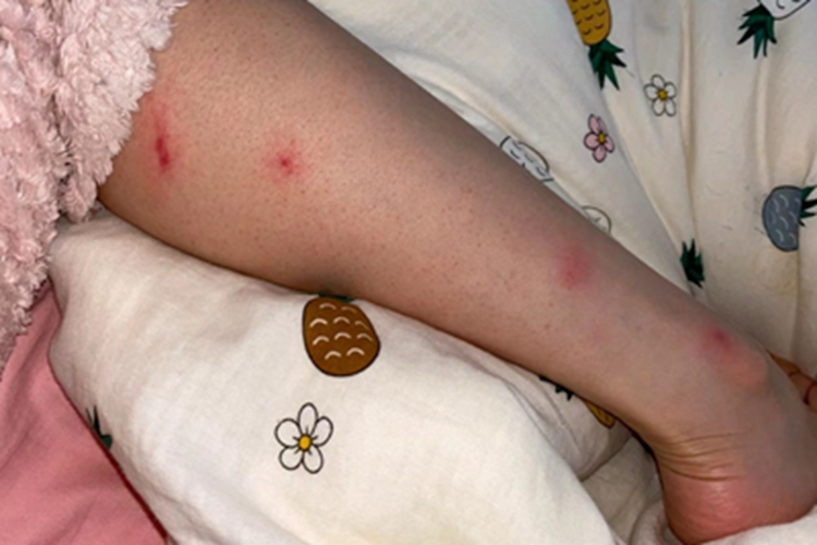 虫咬皮炎小腿斑图 虫咬皮炎小腿斑图