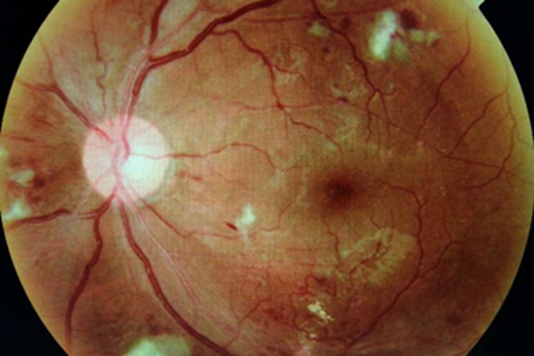 高血压视网膜病变视网膜白斑图 高血压视网膜病变视网膜白斑图