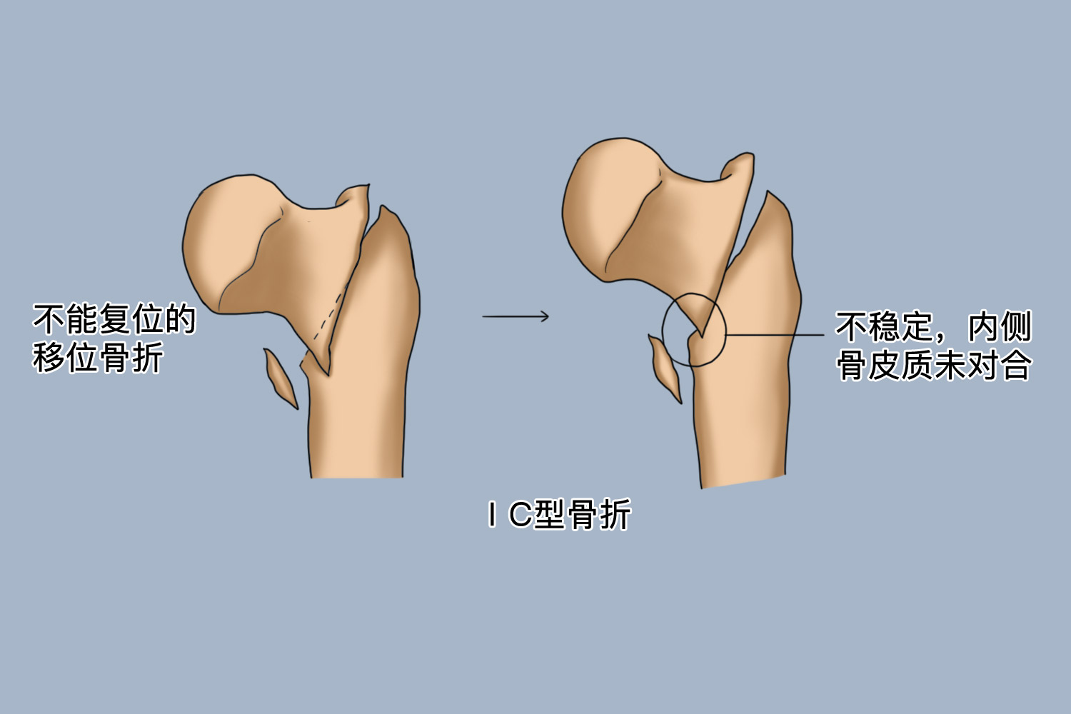 EvansⅠC型骨折图