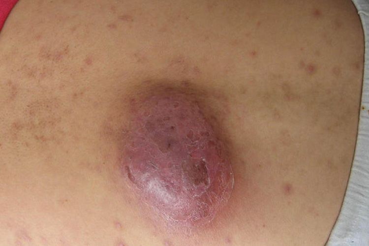 弥漫性炎性硬块图