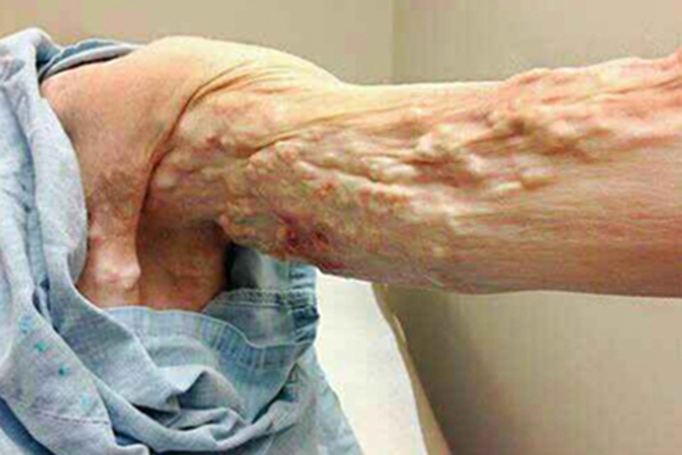 皮肤猪囊虫病胳膊疙瘩图