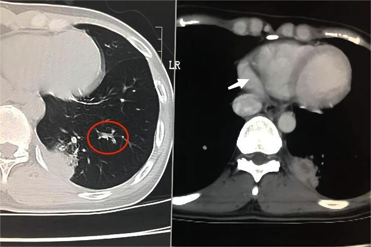 干酪性肺炎CT影像图 干酪性肺炎CT影像图