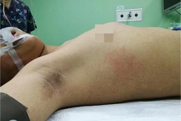 鸡胸胸部异常畸形图