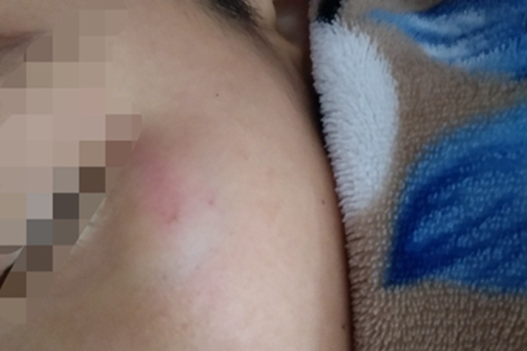 撞伤面部有一块红肿图