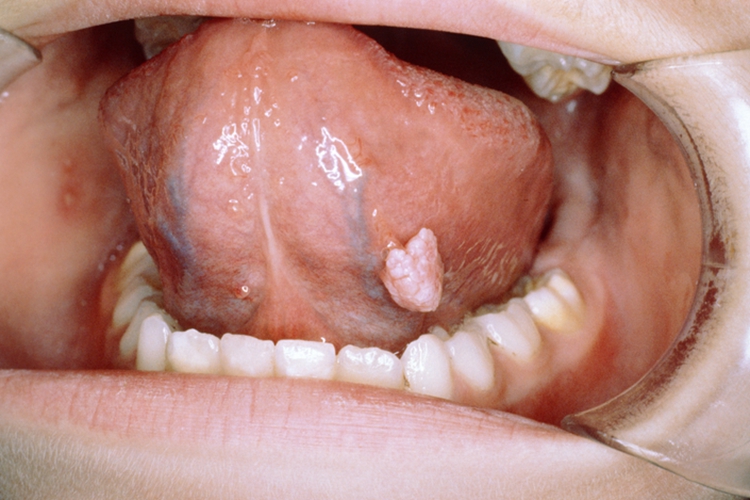 乳头状瘤图 乳头状瘤图