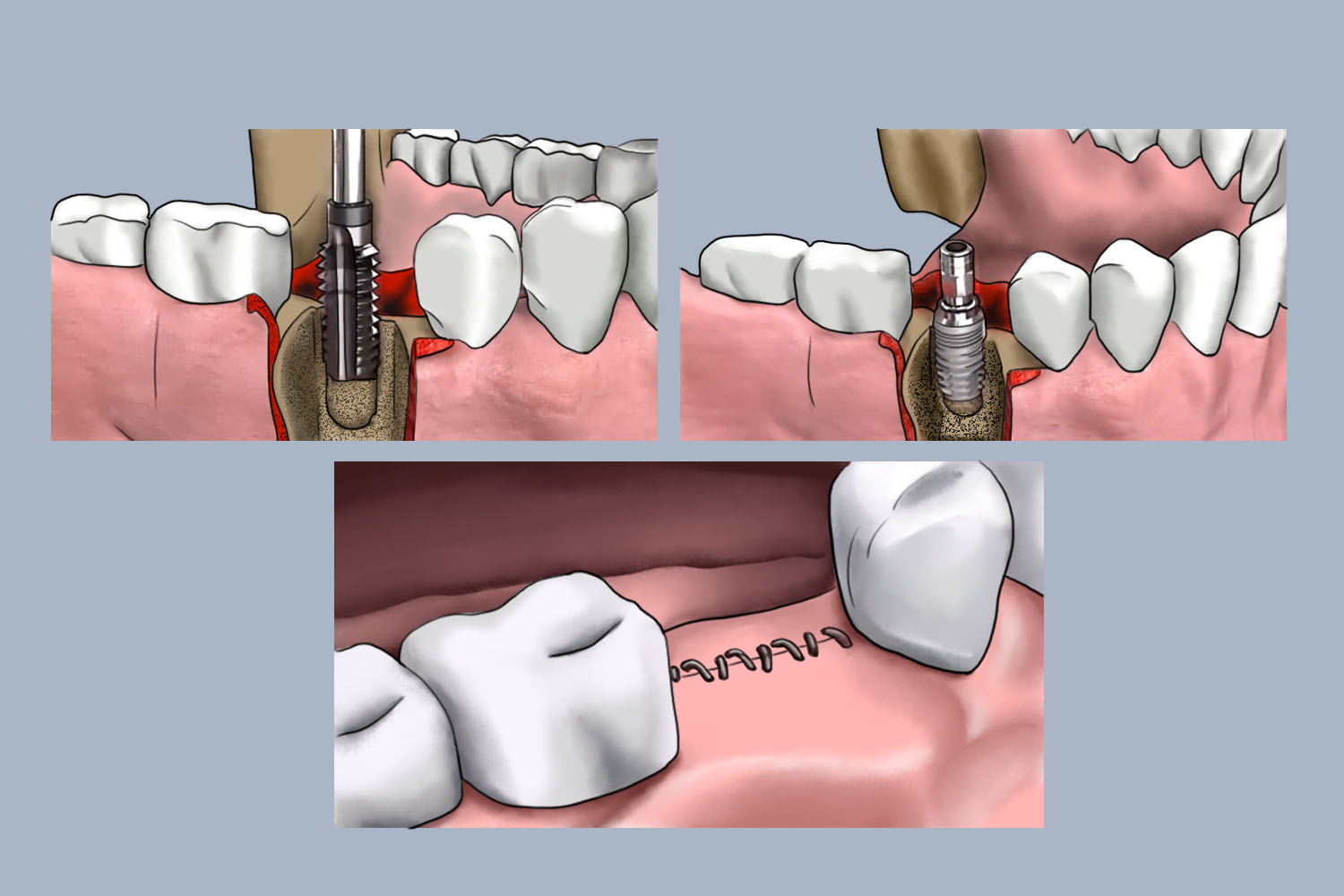 预备螺纹、植入种植体、缝合图 预备螺纹、植入种植体、缝合图