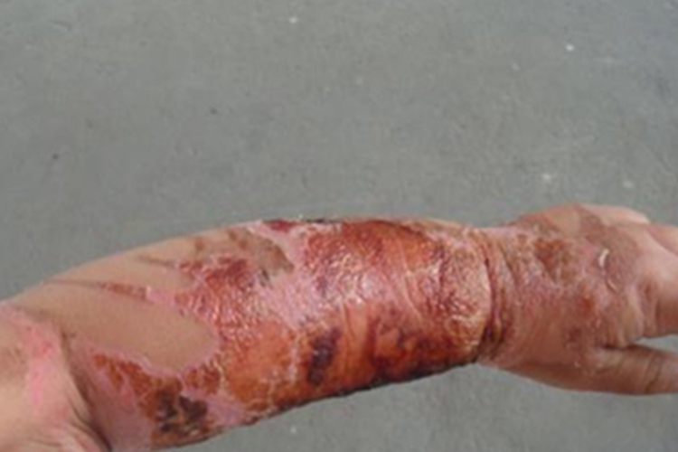 Ⅲ度烧伤胳膊有红痂图 Ⅲ度烧伤胳膊有红痂图