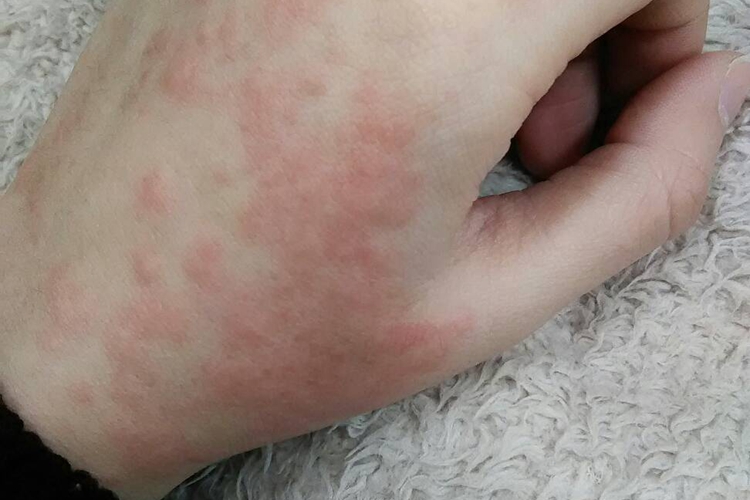 皮肤过敏红肿手背疙瘩图