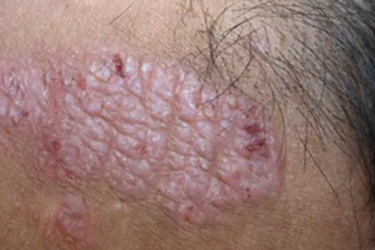 苔藓样型副银屑病症状图 苔藓样型副银屑病症状图