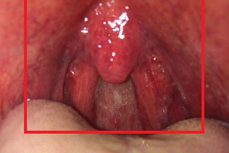 猩红热咽喉症状图 猩红热咽喉症状图