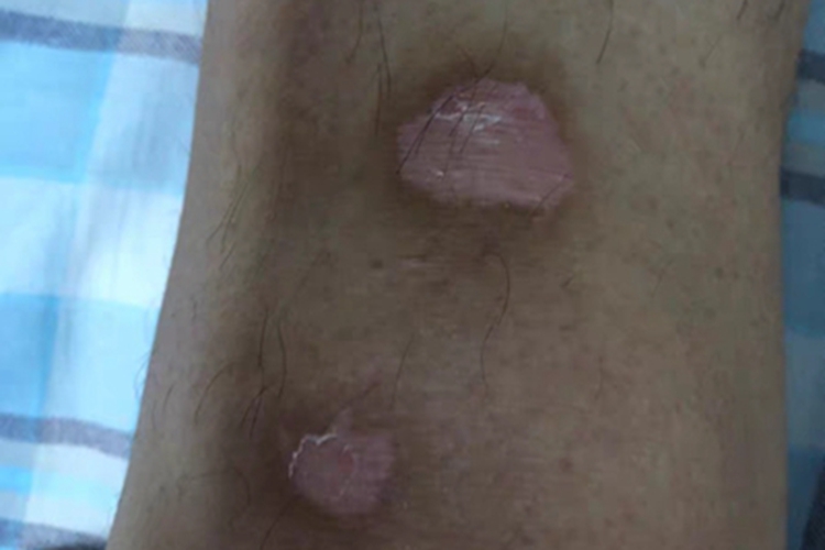 进展期节段型白癜风脱皮图