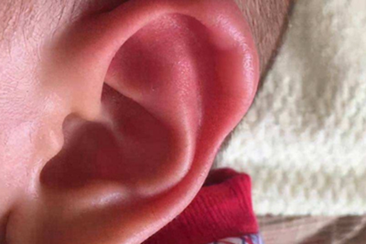 镍皮炎左耳廓发红肿胀图