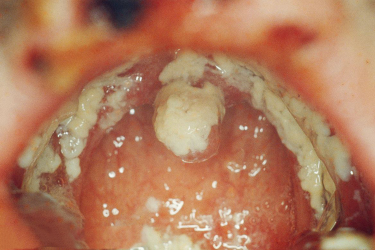 慢性增殖性念珠菌病图 慢性增殖性念珠菌病图