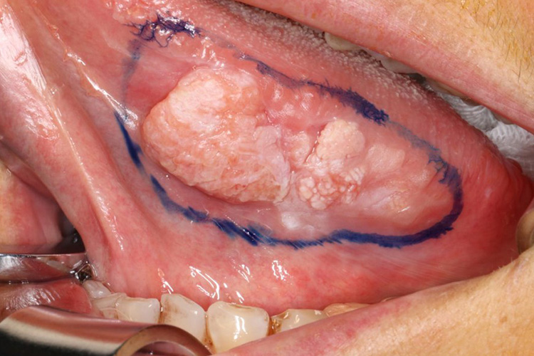 舌头边缘舌癌图