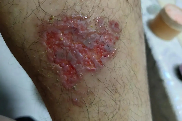 小腿急性湿疹症状图