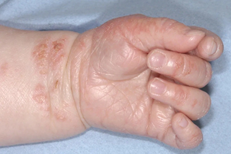 奶癣手部结痂图